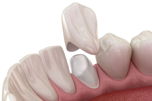 Stump pin tab on canaine tooth. Medically accurate dental 3D illustration